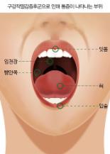 설 명절 지난 후 주부에게 나타난 혀 통증, 치료 방법은