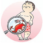 비임균성 요도염 증상..배뇨 시 통증, 분비물, 혈뇨까지?