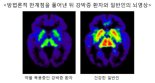 강박증 치료 여부 확인 가능한 세로토닌 수치 밀도 측정 가능