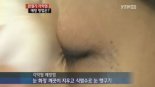 스모키 결막결석, 과도한 눈화장 주의…“눈꺼풀 안 이물질 방치시 발생”