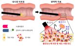 내시경의 암 진단‧치료 효과 높이는 소재 개발