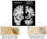 헌팅턴병 환자 뇌 직접 보고 원리 밝혀냈다