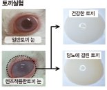 눈물로 당뇨 진단 '스마트 콘택트렌즈' 나왔다