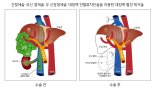 부산 온종합병원, 1년반만에 간담췌암수술 213건 달성