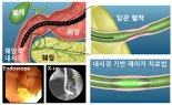 부경대, 담관 협착증 내시경 레이저 치료법 개발