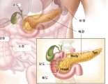 '침묵의 암살자' 췌장암, 이제 분변검사로 쉽게 진단한다