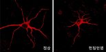 헌팅턴병 일으키는 뇌기능 장애 원인을 찾아냈다