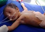 임신한듯 부푼 인도 갓난아기 뱃속에.. 8명의 기생 쌍둥이 '충격'