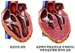 서울대병원 연구진, 비후성심근증 정신질환 연관성 규명