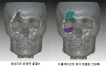 안면골·두개골 결손, 3D프린터 인공뼈로 맞춤 치료