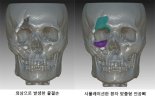 안면 골절 환자 위한 맞춤 인공뼈 3D프린터로 만든다