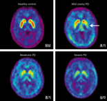 듀켐바이오 방사성의약품 '도파체크주사' 파킨슨 진단 활용