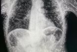 “뭘 먹었길래 몸속에 기생충 수백마리가?“ 의사 경악케한 엑스레이 사진 한 장