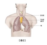 통증·증상 없는 흉선종, 14년간 38% 증가