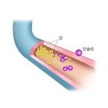 임신성 당뇨 병력에 비알콜성 지방간 있다면.. '이 질환' 주의