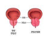 감기약 먹다가 발견한 전립선비대증..'이 증상' 있다면 주의