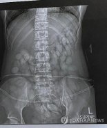 엑스레이 찍어보니 뱃속에 코카인 캡슐 60여개가..남아공서 마약운반책 체포