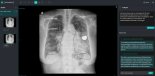 딥노이드, M4CXR, 흉부 X-Ray 판독에서 ChatGPT 보다 '독보적'