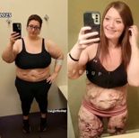 고도비만 여성, '145kg 감량' 성공…피부병 완치까지 [헬스톡]