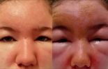 "눈 퉁퉁 붓고, 수포 생겨"..여드름 연고 바를 때 '이 성분' 꼭 확인해야 [헬스톡]