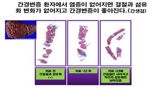 간암 예방의 핵심 열쇠는 ‘간 염증 억제 관리’