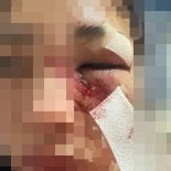 “헤어지자” 했다고…16세 어린 여친 광대뼈 함몰될 때까지 폭행한 30대男