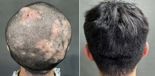 머리에 다닥다닥 빨간 물집 생기더니..20대 男 머리 뭉텅이로 빠지게 한 '이 병'  [헬스톡]