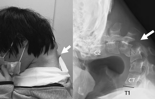 “목뼈가 90도로 꺾였다” 몇 시간씩 폰게임 즐기던 남성의 충격적 엑스레이 [헬스톡]