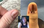 "이 손톱, 바로 병원가세요" '희귀 피부암' 뭐길래 [헬스톡]