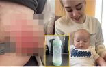 "유방 피부 다 벗겨져" 18세女, 아기 분유병 폭발해 화상 [헬스톡]