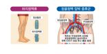 하지정맥류? 장골정맥압박증후군? 헷갈린다면…