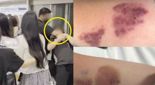 "어깨 부딪혔다고 짐승 다루듯 진압"..걸그룹 경호원에 폭행당한 피해자, 충격 사진 공개