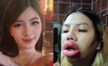 "입술이 왜 이래" …미모의 태국 女, '시술 알레르기 부작용' 뭐길래 [헬스톡]