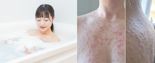 "온몸이 혹처럼 부풀어 올랐다"..호텔 욕조에 30분 몸 담근 20대女, 무슨 일 [헬스톡]