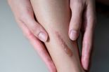 화상환자 후유증 비대성 흉터, '메티오닌' 제한으로 치료
