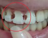 5년간 교정기 꼈는데…'치아 8개에 구멍' 이유가