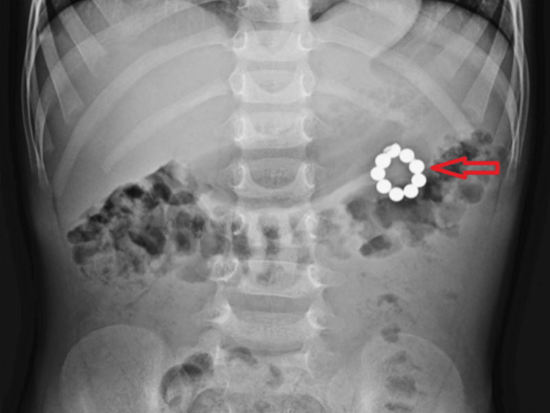국제 학술지 '큐레우스'에 공개된 구슬 자석을 삼켜 응급 개복 수술을 받은 5세 남아의 복부 엑스레이 사진. /사진=큐레우스