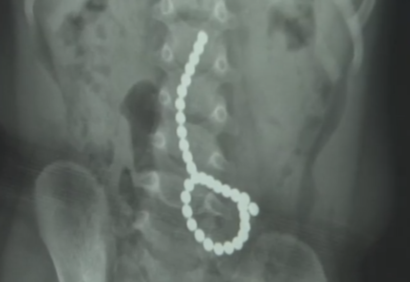 2025년 6월 건양대병원서 구슬 자석을 삼켜 응급 개복 수술을 받은 생후 23개월 남아의 뱃속 엑스레이 모습. /사진=KBS 뉴스 캡처