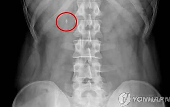 ˝출산과 맞먹는 고통˝... 요로결석의 증상과 예방법