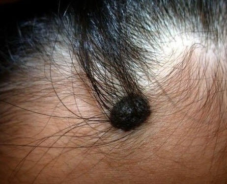 1cm넘는 크고 두꺼운 점, 흉터없이 제거 가능