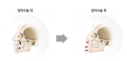 미용 위한 양악수술 꼭 해야 하나