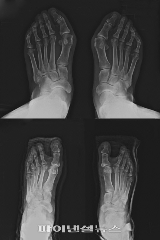 ㅜ지외반증 환자 발 엑스레이 사진. 파이낸셜뉴스