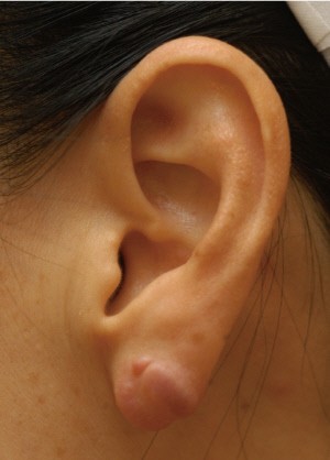 귀걸이 박힌 켈로이드