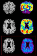 알츠하이머병 환자의 뇌와 정상인(붉은 색 박스 안)의 뇌 - 노란색과 붉은색으로 보이는 곳이 치매를 일으키는 물질