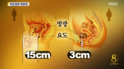 여성에게 흔한 질환 ‘방광염’, 원인과 예방법은?