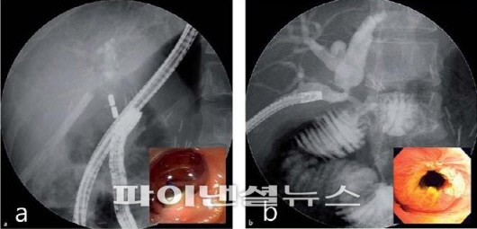 a. 자석은 대장 내시경시 용종을 제거하는 올가미를 사용하여 부착하며 다른 자석은 경피경간 담도 배액술(PTBD)에 의해 확보된 요로를 통해 이동시켜 두 자석이 서로 영향을 주도록 만든다. b. 내주 경피경간의 담도경(PTCS) 카테터를 제거하면 문합부 개통을 확인할 수 있다.