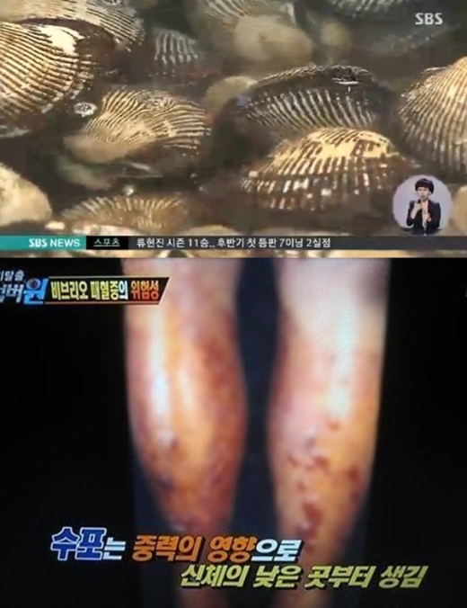 비브리오패혈증 증상, 빠른 진행 속도에 치사율 50% 이상... 특히 ‘이것’ 조심!