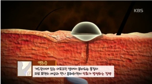 여름 불청객 ‘액취증’, 어떻게 대처해야 할까?