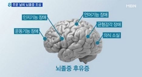 뇌졸중의 종류와 원인, 뇌경색-뇌출혈.. 심하면 치매까지