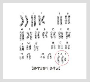클라인펠터증후군 현직 女경찰관 숨지 채 발견 ‘어떤 병이길래 자살까지?’